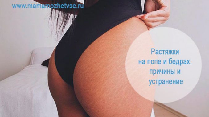 Растяжки на попе и бедрах Растяжки на попе и бедрах
