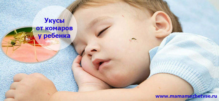 Как лечить укус комара у ребенка
