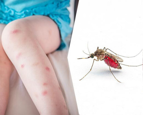 Как и чем лечить укусы комаров у ребенка