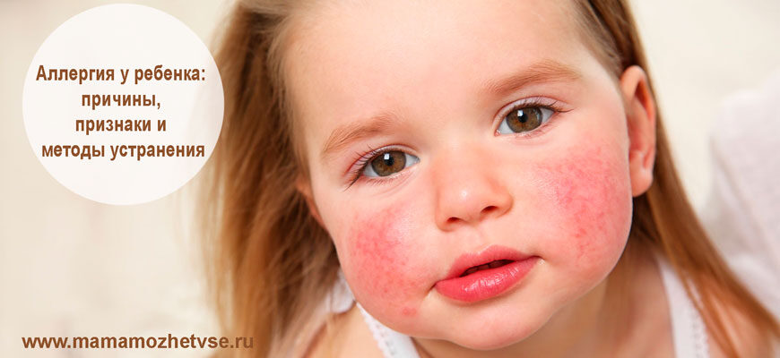 аллергия у ребенка причины, методы устранения 1