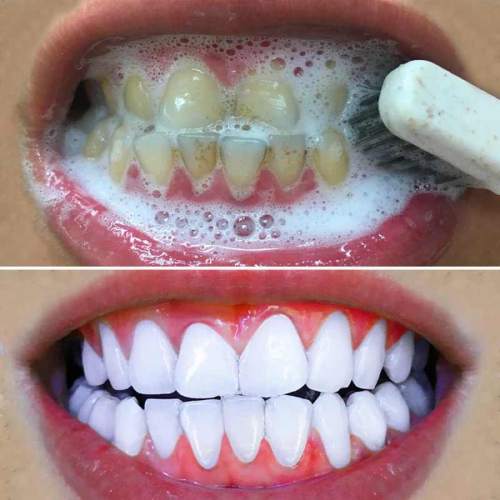 отбеливаем зубы в домашних условиях