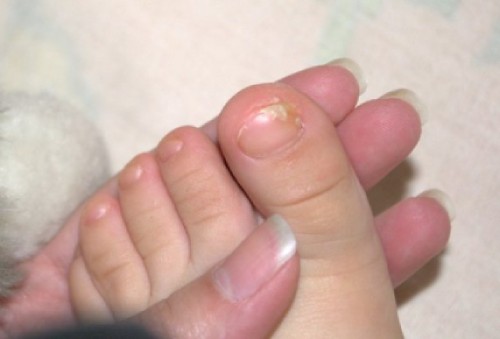 У ребенка слоятся ногти на ногах