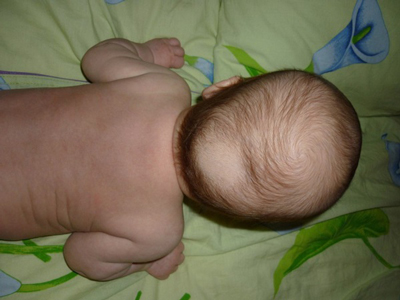 почему у новорожденного выпадают волосы на голове