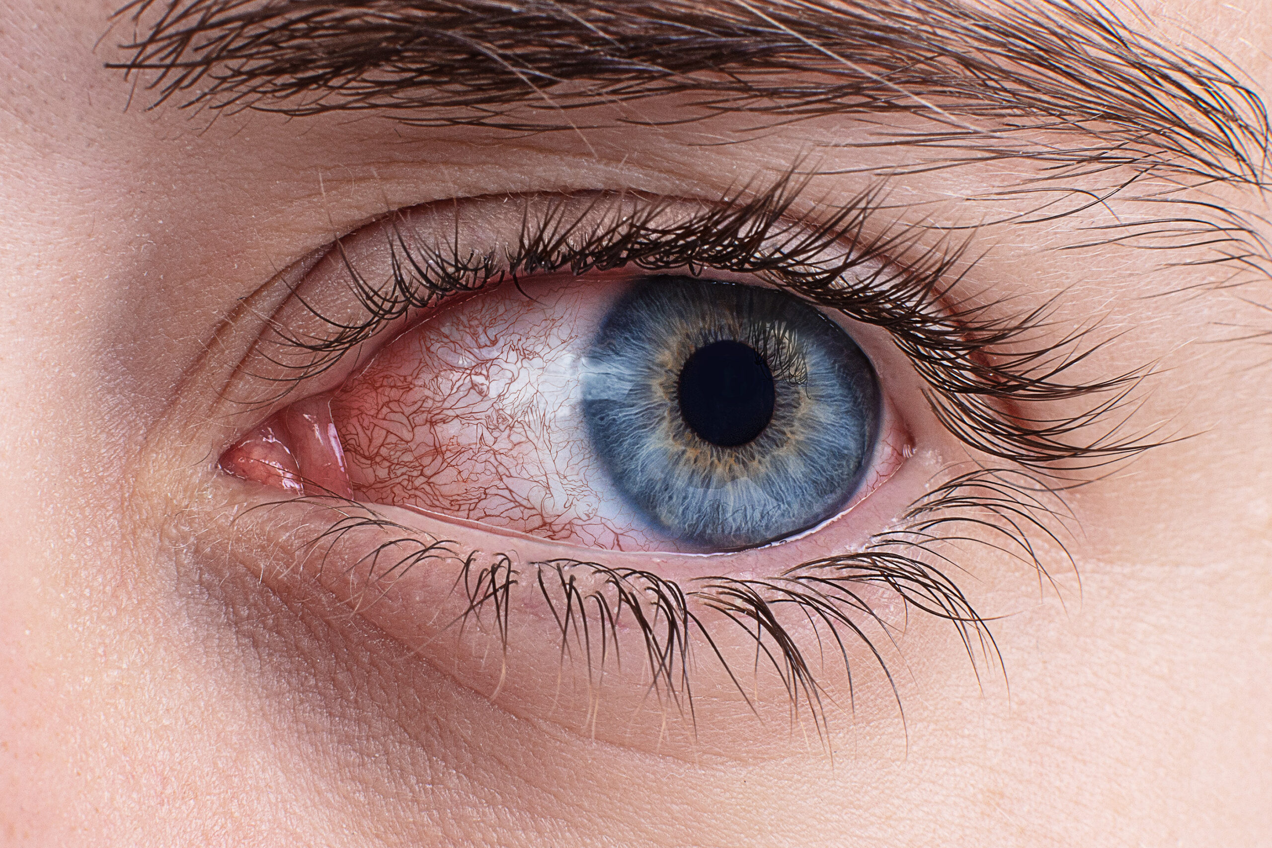 синдром сухого глаза